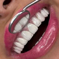 کامپوزیت با تخفیف۵۰درصدی+اقساط ویژه کلینیک سرو
