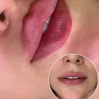 ژل،بوتاکس،پرسینگ،مزو ژل،چال لپ