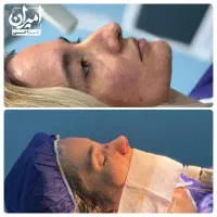 جراحی بینی/عمل بینی/ اقساط 12 ماهه