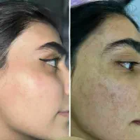 فقط طی چندروز،پوستتوچنددرجه روشنتروبی لک میکنه