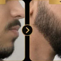 رویش مجدد ریش