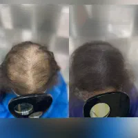 میکرواسکالپ،مکمل کاشت،رفع طاسی سر،اسکالپ رشت