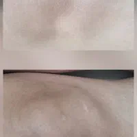 روشن شدن نواحی تیره بدن