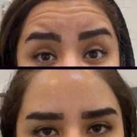 تزریق بوتاکس و ژل
