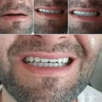 لمینت مترحک دندان اصل|آرایشی، بهداشتی، درمانی|ایلام, |دیوار