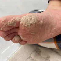 روغن خال و زگیل و میخچه و زکیل تناسلی