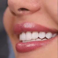 ۱۵درصد تخفیف روی خدمات ایمپلنت به مدت محدود|خدمات آرایشگری و زیبایی|تبریز, |دیوار