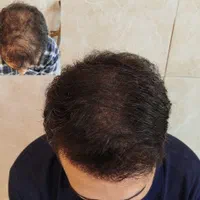 میکرو اسکالپ.اولین مرکز تخصصی میکرو اسکالپ در کرج|خدمات آرایشگری و زیبایی|کرج, عظیمیه|دیوار