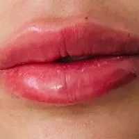 تزریق ژل و بوتاکس(نتیجه طبیعی + ۵۰٪ تخفیف ژل)