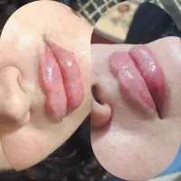ژل بوتاکس مزو مو ابرو خالبرداری