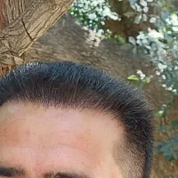 کاشت مو و ابرو قسطی در شیراز|خدمات آرایشگری و زیبایی|شیراز, قصرالدشت|دیوار