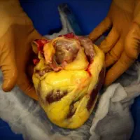 دمنوش گرفتگی عروق فشار خون و چربی خون