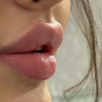 ژل وبوتاکس وریموتتو توسط پزشک