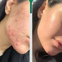 محلول جوش و کرم دور چشم