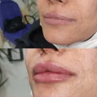 تخفیف ویژه خدمات ژل و بوتاکس|خدمات آرایشگری و زیبایی|زابل, |دیوار