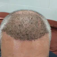 کاشت مو شروع با ۸ میلیون|خدمات آرایشگری و زیبایی|تهران, شهرک صادقیه|دیوار