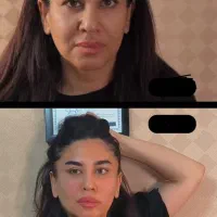 فیلر/بایو فیلر/ فیلر طبیعی/ جوانساز/ فیلر صورت