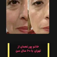 کرم بوتاکس صورت|آرایشی، بهداشتی، درمانی|اهواز, کیان اباد|دیوار