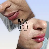 تزریق ژل و بوتاکس|خدمات آرایشگری و زیبایی|جهرم, |دیوار