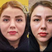 بلفاروپلاستی کاشت مووابروباضمانت کتبی (نقد واقساط)