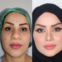 عمل جراحی بینی وترمیم باپیزو/لیفت صورت وپلک|خدمات آرایشگری و زیبایی|کرج, چهارصد دستگاه|دیوار