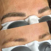 پاک‌کردن تتو ابرو و بدن با لیزر توسط پزشک