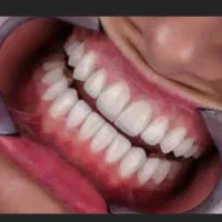 کامپوزیت لمینت «چکی و با سفته»»درمشهد