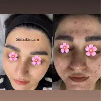 درمان مشکلات پوست وفیشیال حرفه ای