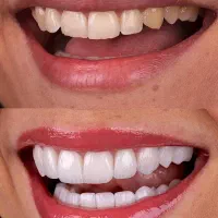 دندان مصنوعی تحویل( ۵ساعته)،کامپوزیت دندان ، روکش|خدمات آرایشگری و زیبایی|تهران, میدان ولیعصر|دیوار