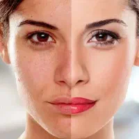 لابیا پلاستی‌وسفیدی‌دائمی بیکینی به صورت اقساط