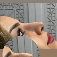 جشنواره پی آرپی ژل و بوتاکس مزوتراپی بلفارو|خدمات آرایشگری و زیبایی|اهواز, کیانپارس |دیوار