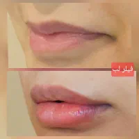 خدمات تخصصی بوتاکس و فیلر در منزل (پزشک مجرب)|خدمات آرایشگری و زیبایی|تهران, اباذر|دیوار