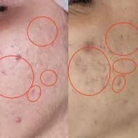 فیشال درمان آکنه و جای جوش