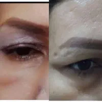 کوچک کردن بینی.رفع افتادگی‌پلک و چروک صورت|خدمات آرایشگری و زیبایی|زاهدان, |دیوار