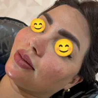 ژل و بوتاکس مزوتراپی و مزونیدلینگ آرایش دایم|خدمات آرایشگری و زیبایی|اردکان, |دیوار