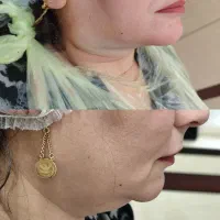 آف تخلیه غبغب وپی ارپی|خدمات آرایشگری و زیبایی|خرمشهر, |دیوار