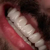 کامپوزیت دندان سارمکو کاریزما ای پی اس|خدمات زیبایی و سلامت|تهران, نارمک جنوبی|دیوار