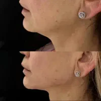 تزریقات ژل و بوتاکس