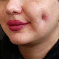 فیلر،بوتاکس،پلکسر،مزونیدلینگ، پیرسینگ و چال گونه|خدمات آرایشگری و زیبایی|اردکان, |دیوار