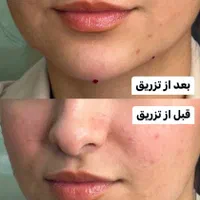 اگزوزوم/ریزش سکه ای/مزوتراپی/فیشیال/ریموو تاتو|خدمات آرایشگری و زیبایی|شیراز, کاراندیش|دیوار