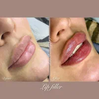 جشنواره تزریق ژل و بوتاکس (تحت نظرپزشک)|خدمات آرایشگری و زیبایی|اصفهان, خلجا|دیوار