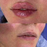 تزریق چربی وفیلر لابیاپلاستی وغبغب ژل لب هیپ دیپ|خدمات زیبایی و سلامت|تهران, شکوفه (عبدل آباد)|دیوار