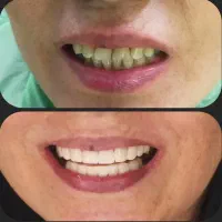 زیبایی،کامپوزیت دندان،عصب کشی(یاسوج)|خدمات آرایشگری و زیبایی|دوگنبدان, |دیوار