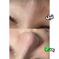 پاکسازی پوست تخفیف یلدا تضمینی|خدمات آرایشگری و زیبایی|ارومیه, |دیوار