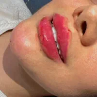 تزریق ژل و بوتاکس با آموزش