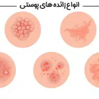 واکسنhpv زیگیل تناسلی زنان زائده پوستی ترمیم ..
