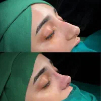 جراحی زیبایی بینی رینوپلاستی اصفهان توسط متخصص ent