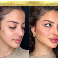جشنواره تزریق ژل،فیلر،بوتاکس باقیمت کم هفده شهریور