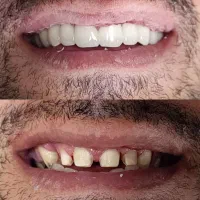 خدمات دندانپزشکی.روکش.کامپوزیت