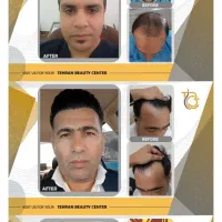 کاشت مو/زیبایی/ ضمانت کتبی/پزشک متخصص/اقساط|خدمات آرایشگری و زیبایی|پاکدشت, پاکدشت (مامازند)|دیوار